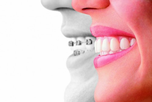 Straight Talk: Invisalign First for Early Orthodontic Treatment